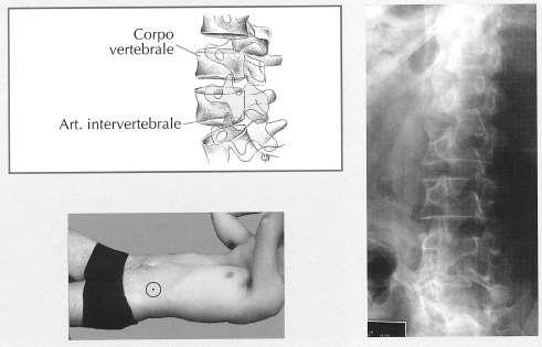 PROIEZIONE OBLIQUA Posizione del paziente e risultato