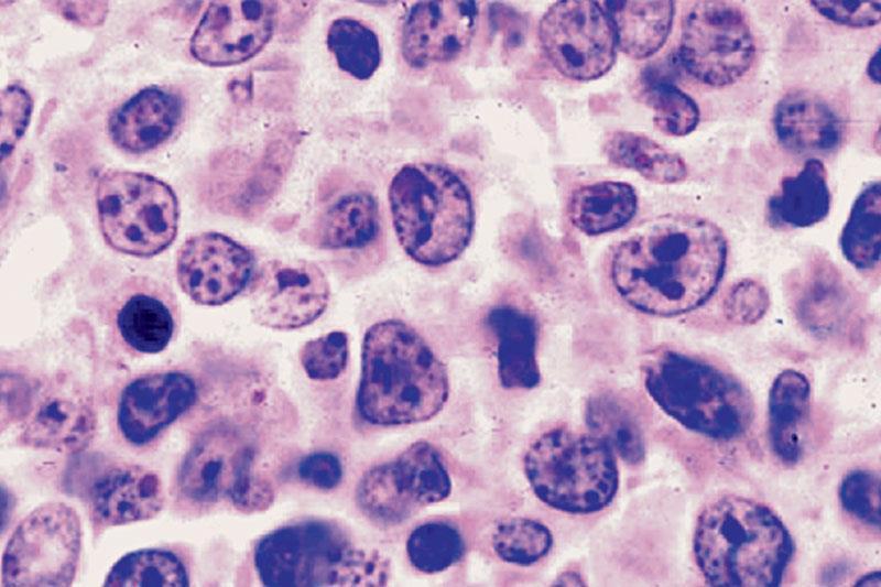 Linfoma diffuso a grandi cellule B Caratteristiche - 30-35% LNH - Età media 65 anni (5% dei linfomi pediatrici) - Sopravvivenza 61% a 5 anni - conferma istologica 91% DIAGNOSI BIOPSIA LINFONODALE/D