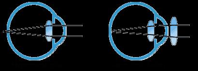 IPERMETROPIA Si corregge con occhiali o lenti a