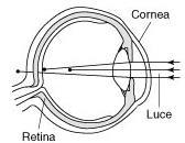 ASTIGMATISMO Nell astigmatico la cornea non è perfettamente sferica, ma assume una curvatura simile a quella di un cucchiaio da cucina