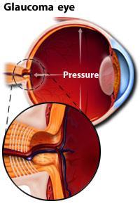 GLAUCOMA È caratterizzato dall aumento della pressione intraoculare.