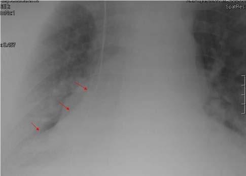 supero-mediale della grande scissura in posizione più bassa che di norma (vedi FIG. 1b). Se ne deduce una perdita di volume del lobo inferiore destro. FIG. 2B SCOUTVIEW DELLO STESSO PAZIENTE DI FIG.