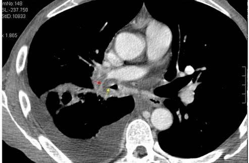 apprezza infatti solo l emidiaframma sinistro (frecce gialle). FIG. 5A STESSO PAZIENTE DI FIGG. 3,4. SCANSIONE TC PASSANTE PER L ILO DESTRO.