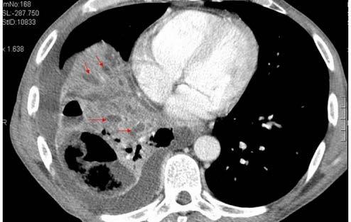 FIG. 5B SCANSIONE TC PASSANTE PER I LOBI INFERIORI.