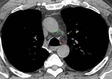 FIG. 4A FINESTRA AORTO-POLMONARE.