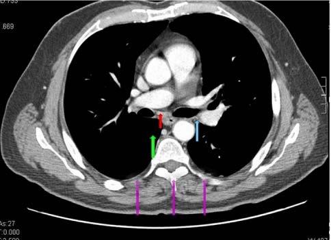 FIG. 3 SCANSIONE TC PASSANTE PER L ARCO DELL AZYGOS E LA FINESTRA AORTO-POLMONARE.