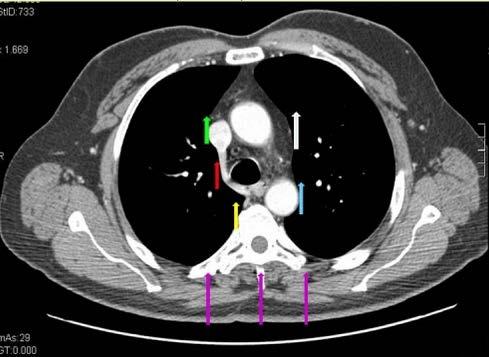 livello del profilo destro della vena cava superiore (freccia verde), dell arco dell azygos (freccia rossa), del profilo destro del soma vertebrale (freccia gialla), della finestra aorto-polmonare