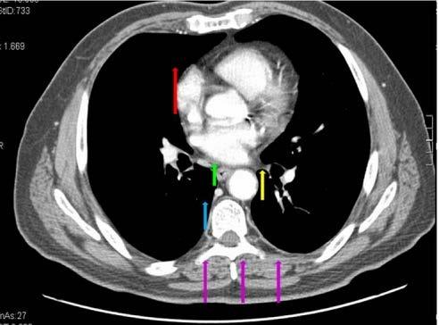 FIG. 5 SCANSIONE PASSANTE PER L ATRIO SINISTRO.