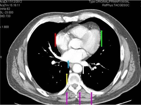 livello dell atrio destro (freccia rossa), della parete laterale destra dell esofago (freccia verde), del profilo destro del soma vertebrale (freccia blu), e della parete laterale sinistra dell aorta