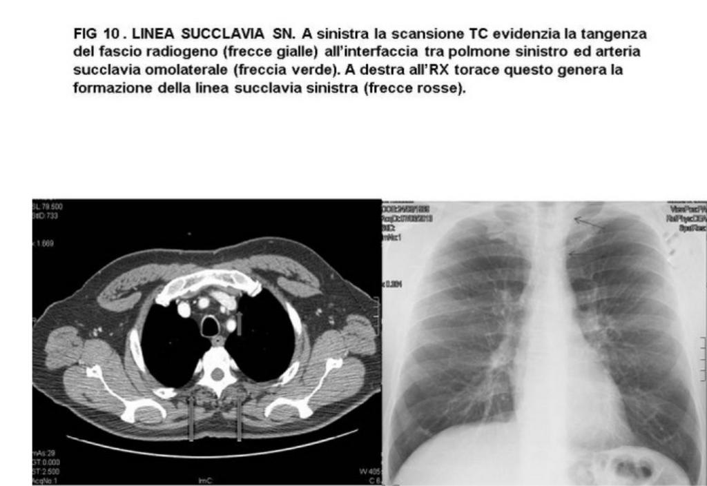 FIG. 10 LINEA SUCCLAVIA SINISTRA.