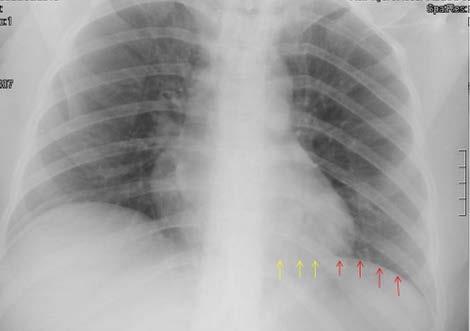 FIG. 6A PROIEZIONE P-A in barella, eseguita in paziente fortemente tachipnoica. Il radiogramma appare sostanzialmente negativo per alterazioni pleuro-parenchimali in atto.