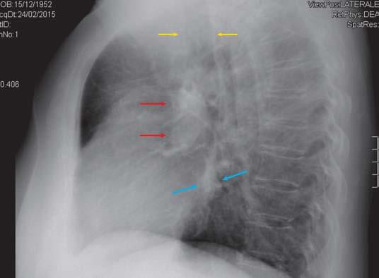 FIG.1 PROIEZIONE L-L DEL TORACE.