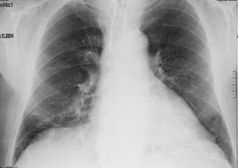 FIG. 15b PROIEZIONE L-L.