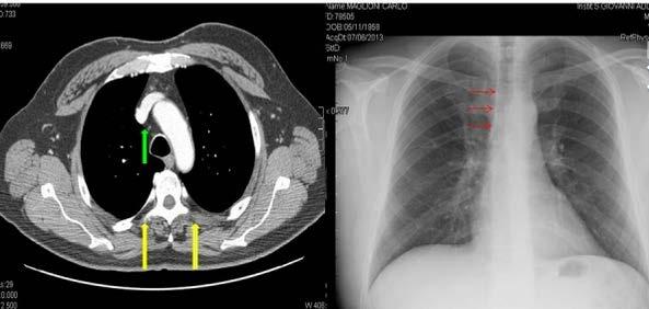 FIG. 3A LINEA PARACAVALE (I ARCO DX).