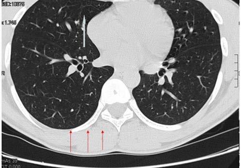 FIG. 1 SCANSIONE TC PASSANTE PER IL LOBO MEDIO.