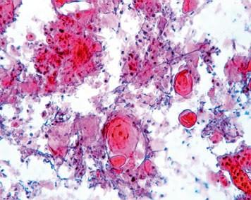 cytology for diagnosisi of canine mammray tumors: comparative features with human