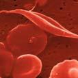 com/ Anemia falciforme (2) Le persone con anemia falciforme ( sickle cell anemia ) producono una forma di emoglobina A diversa, detta emoglobina S (S sta per sickle ).