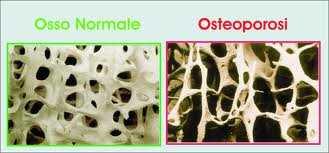 OSTEOPOROSI Malattia dello scheletro caratterizzata da: - una diminuita massa ossea - da un