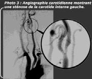 I cut-off angiografici sono tre: per i casi sintomatici è richiesto di discriminare stenosi >50% e>70%, per i casi asintomatici le stenosi >60%.