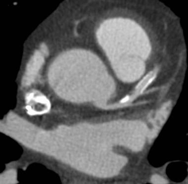Cardiopatia ischemica nota: PCI Artefatti (da movimento, volume parziale, «blooming»*) Stent >3 mm: 89% valutabili Restenosi in-stent >50%: sens. 90%, spec.