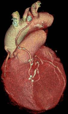 Cardiopatia ischemica nota: BAC Paziente sintomatico dopo BAC Graft venosi ben valutabili per > diametro (3-4 mm) e