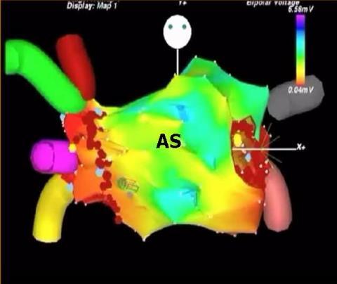 mappe elettro-anatomiche Complicanze postprocedura (stenosi,