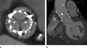 Aorta toracica TAVI Gold standard patologie aortiche (aneurisma, dissezione,