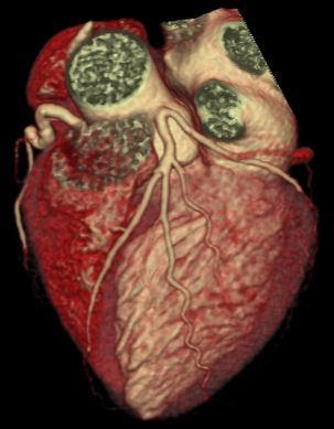 TC cardiaca TC a 64 strati o > (fino a 320) Elevata risoluzione spaziale (o,5 mm) Discreta risoluzione temporale (~160 ms a 64 slice)