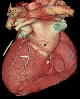 TC cardiaca: sincronizzazione («gating») ECG Fasi di minimo movimento del cuore: mesodiastole (diastasi) o telesistole Retrospettivo: acquisizione «spirale» lungo tutto il ciclo cardiaco («low
