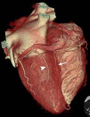 TC cardiaca: riduzione dose Dose media elevata (8-18 msv); oggi anche < 5 msv CVG: 3-9 msv Acquisizione «step and shoot», gating prospettico