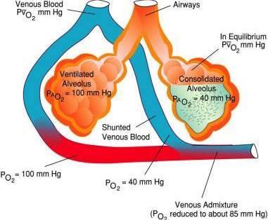 SHUNT Condizione estrema della riduzione del rapporto VA/Q: il sangue attraversa capillari polmonari a