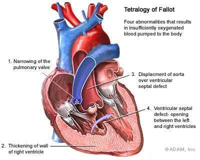 consolidamento polmonitico, Sdr distress respiratorio, fistole artero-venose SHUNT EXTRAPOLMONARI: