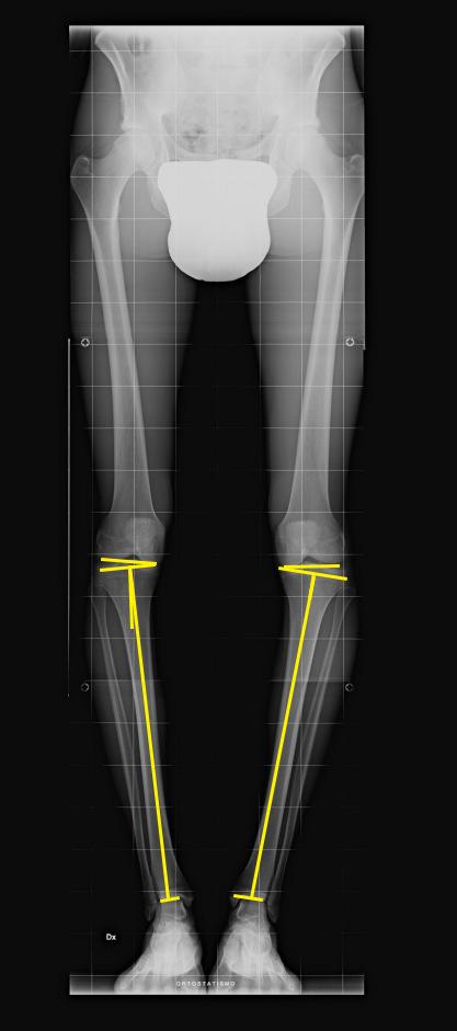 singoli segmenti (linea verde); si riportano gli assi anatomici e i JLCA (linea