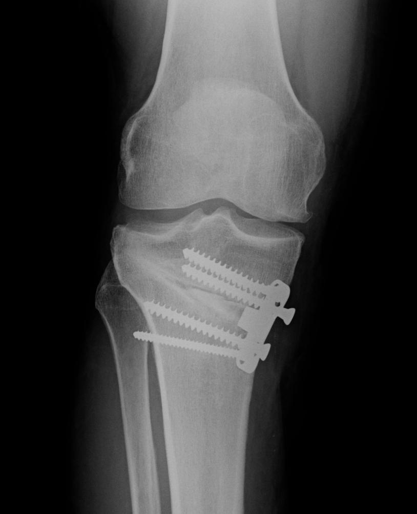 Fig. 46 Osteotomia a cuneo aperto fissata con placca di Puddu. Fig.