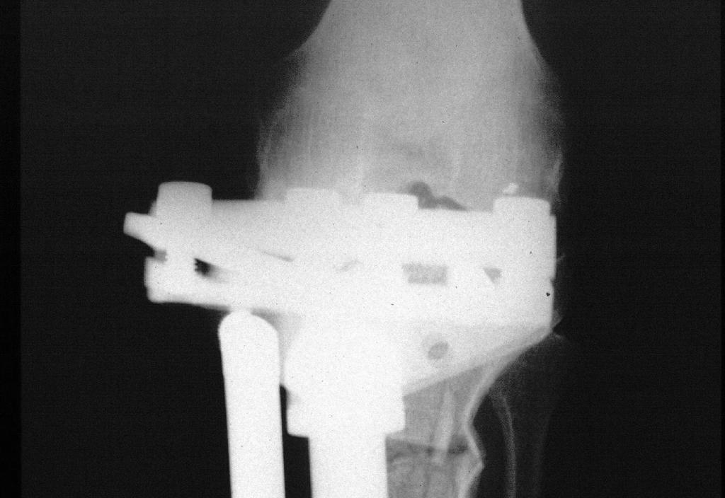 posizionamento, il morsetto in sede metafisaria è fissato per mezzo di due viti in leggera convergenza, mentre il braccio si posiziona lungo l asse della tibia