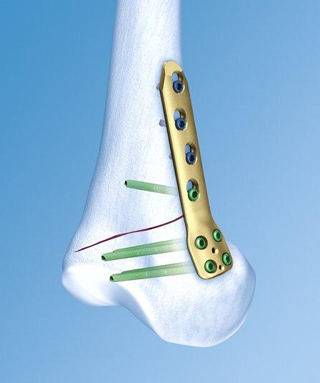 distale, a distanza calcolata con la formula sopra descritta, e inserito in senso prossimale e mediale, verso il primo filo. A questo punto si procede alla rimozione del tessuto osseo.