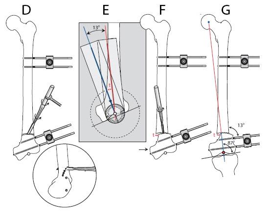Si procede quindi a praticare l osteotomia curvilinea: per tale compito si rende necessario l impiego di particolari strumenti a compasso come quello mostrato in figura 53, che consentono di creare