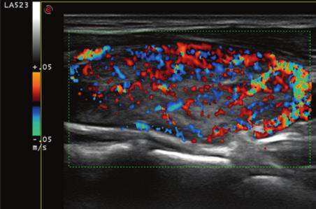 Dimagrimento anomalo, un caso di iperfunzione tiroidea Figura 1. Aumento vascolarizzazione diffusa lobo tiroideo in malattia di Basedow (inferno tiroideo).