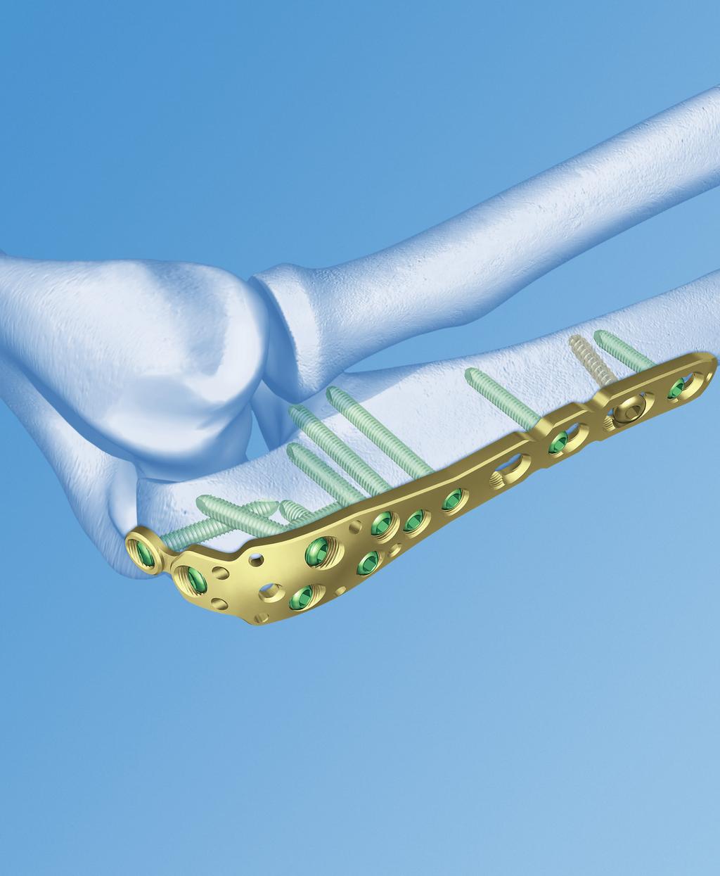 Placca LCP per olecrano. Sistema di fissazione anatomica per fratture dell olecrano e dell ulna prossimale con stabilità angolare.