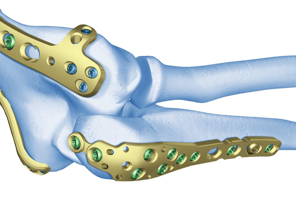 Placca LCP per olecrano. Sistema di fissazione anatomica per fratture dell olecrano e dell ulna prossimale con stabilità angolare.