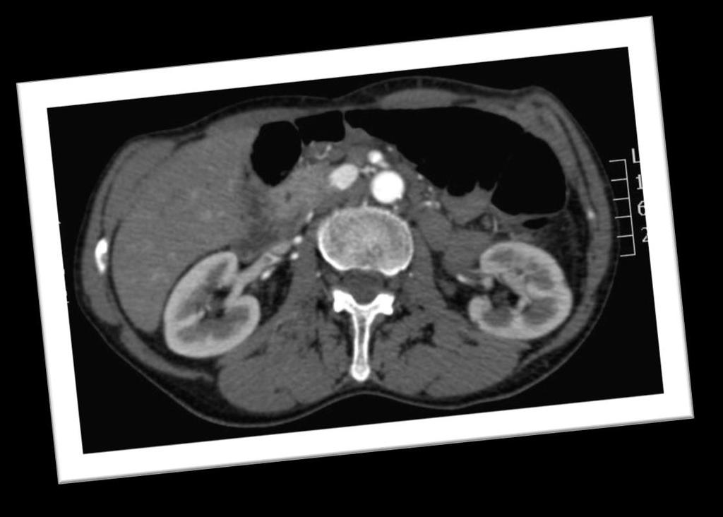Aprile 2009 - TAC formazione tondeggiante a margini regolari di 17 x 14 mm a livello dell istmo pancreatico sospetta per lesione primitiva neuroendocrina.