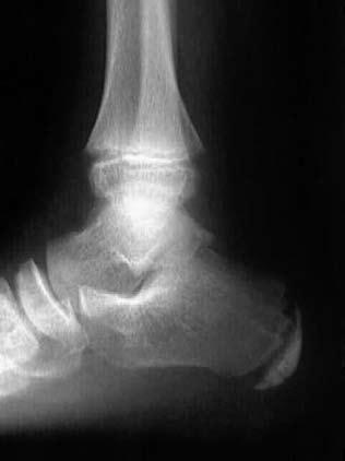 I danni non traumatici da sport Figura 3. Quadro radiografico di malattia di Sever-Blenke (proiezione laterale del calcagno).