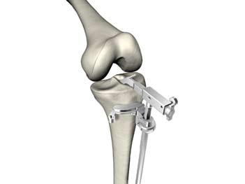 Triathlon PKR Protocollo chirurgico Assemblaggio della cavigliera u Il braccio di fissaggio della barra prossimale è completamente esteso per raggiungere l'eminenza prossimale su di un area esposta