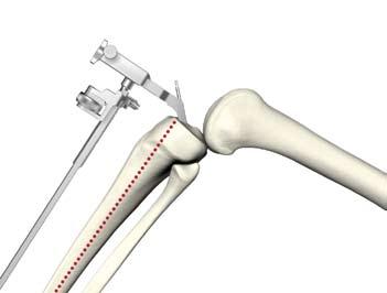 Figura 6 Nota: Estendendo completamente il braccio di fissaggio prima di collegarlo all'eminenzia tibiale consente la clearance della guida di resezione tibiale.