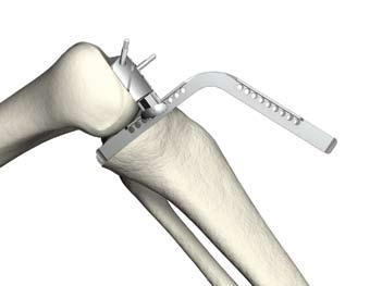 Se si preferisce, è possibile iniziare la resezione distale in estensione e terminare in flessione. Lo spaziatore deve essere rimosso dall'articolazione prima di mettere in flessione il ginocchio.