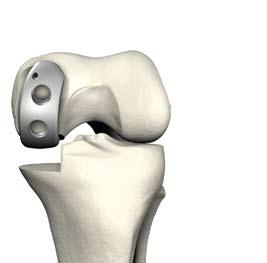 Triathlon PKR Protocollo chirurgico Sbagliato Prova femorale u Posizionare il ginocchio a una
