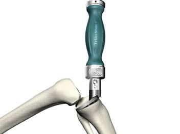 Cementazione Figura 38 Cementazione tibiale u Applicare il cemento su entrambe le superfici della protesi e dell'osso per ottenere una migliore interdigitazione.