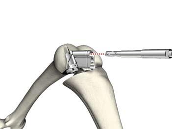 Preparazione alternativa del femore u Dopo aver eseguito la resezione smussa e la resezione posteriore sul femore, è possibile usare il blocco di taglio 2 in 1 per preparare i fori per i perni