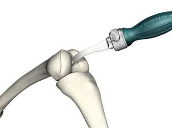 Triathlon PKR Protocollo chirurgico Preparazione tibiale La protesi Triathlon PKR applica un approccio tibiafirst all'artroplastica unicompartimentale.