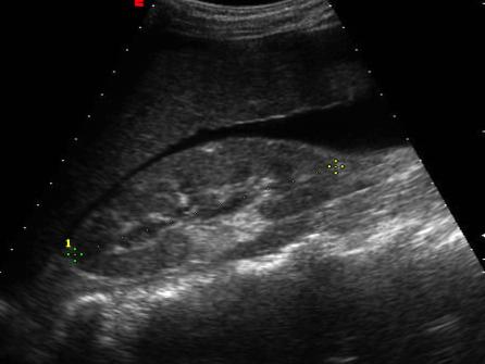 Sindrome Epato-Renale Ascite